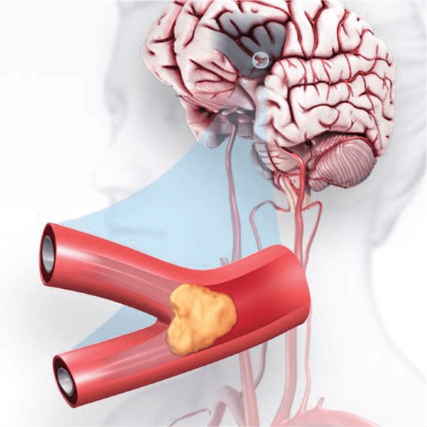 how do you know if you had a stroke